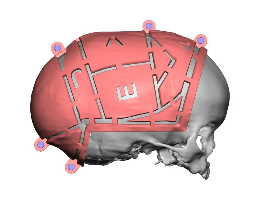 3d systems vsp cranial preop guides render