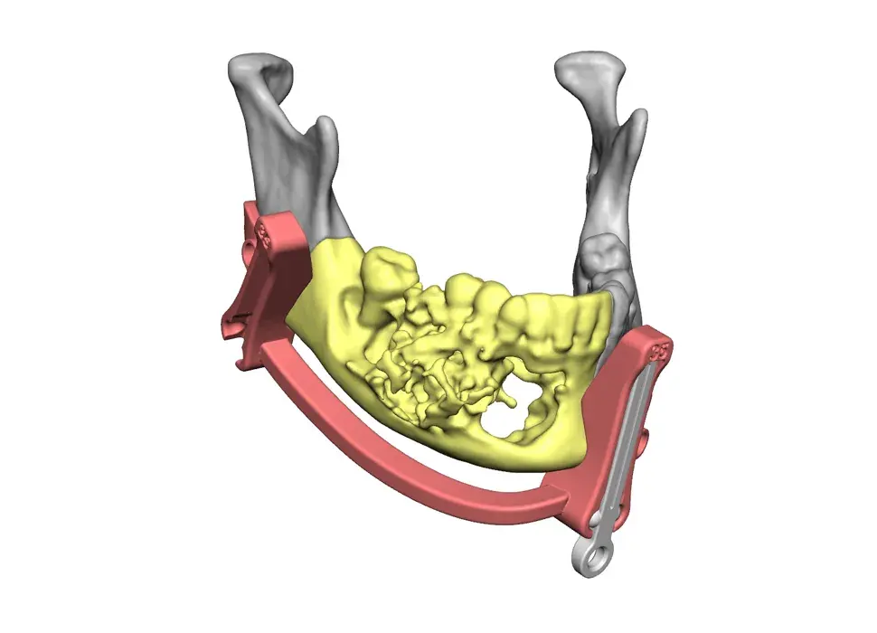 VSP Reconstruction mandible with cutting guide
