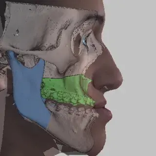 vsp orthognathics real-time 3d-bony movement ceph analysis