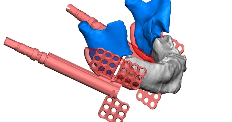 3D Systems VSP Distraction planning image with distractor