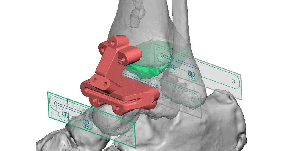 Vantage ankle psi osteotomy guide design