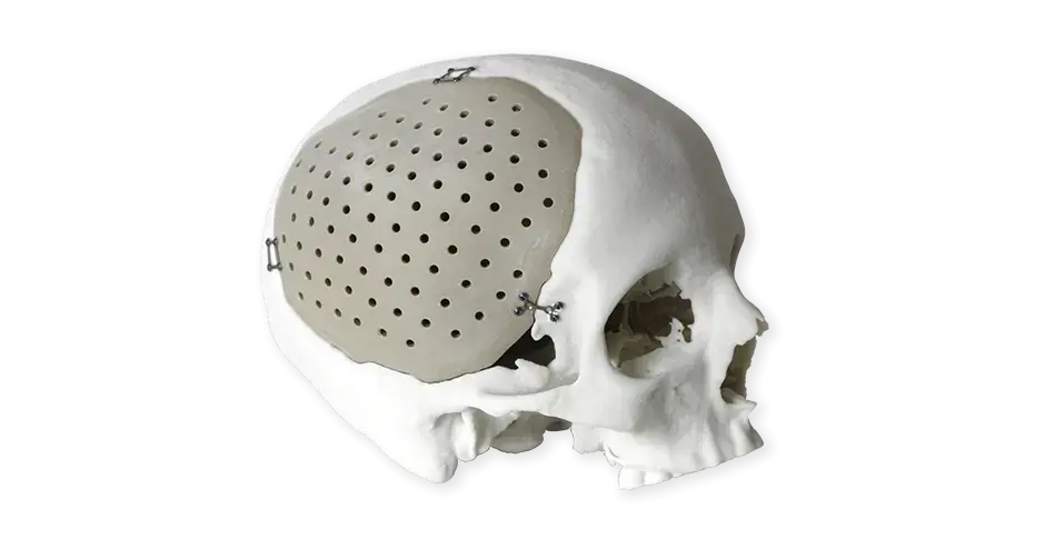 Implantes cranianos em PEEK