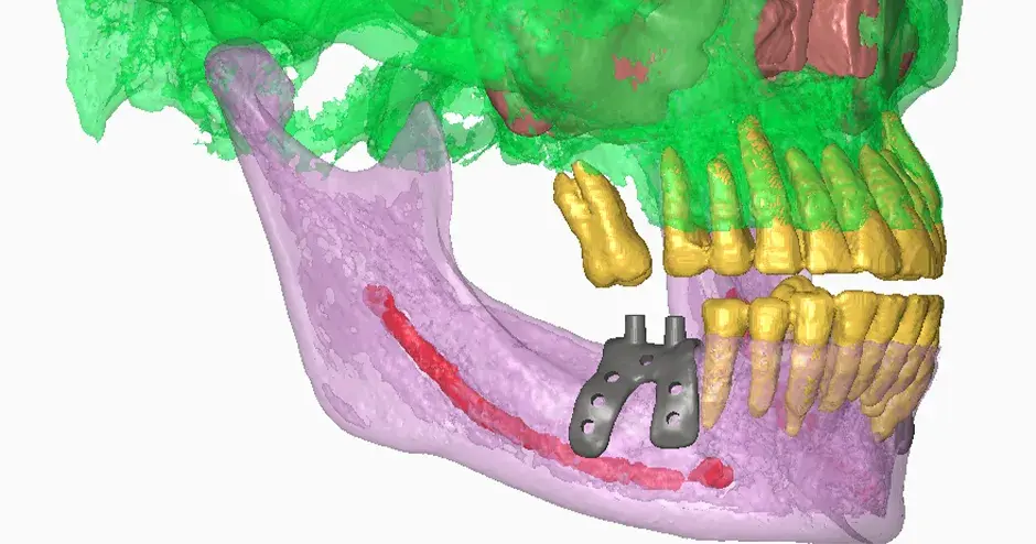 Implantes dentários da Graft3D