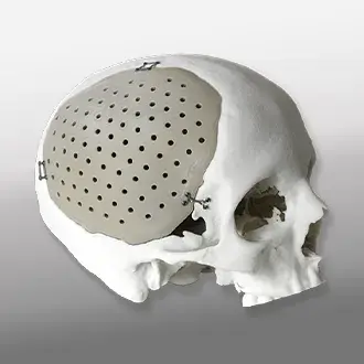 um crânio com uma placa craniana impressa em 3D