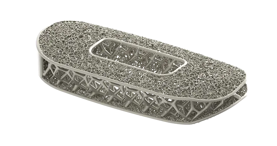 Implante espinhal otimizado pela NuVasive produzido usando a impressão 3D 